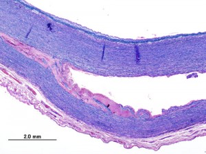 Aortic dissection stained with Victoria blue HE Aortic dissection stained with Victoria blue HE