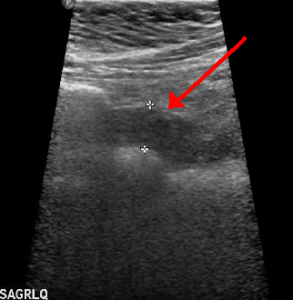 appendicitis ultrasound image
