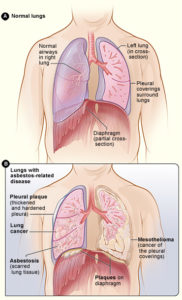 asbestos effect