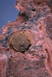 Aspergilloma in old tuberculous cavity
