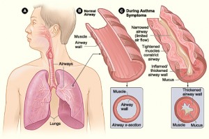 Asthma-attack-illustration