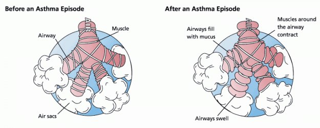 Asthma-before-after