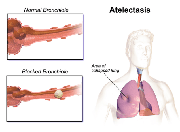 Atelectasis Atelectasis