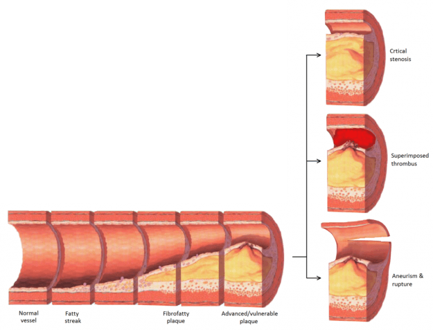 Atherosclerosis disease progression Atherosclerosis disease progression