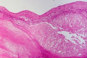 Atherosclerosis Atherosclerosis