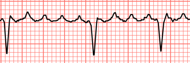 Atrial flutter with variable block Atrial flutter with variable block