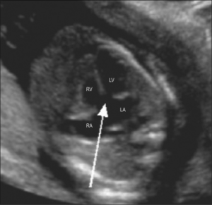 Atrioventricular septal defect. Four-chamber view Atrioventricular septal defect. Four-chamber view