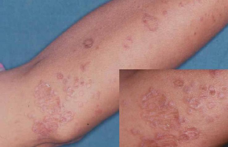 Lichen Planus Lichen Ruber Planus — Causes And Symptoms Lecturio