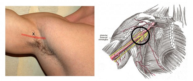 Left: puncture of the axillary block via the axillary artery. Right: the course of the artery and nerve, place of elimination