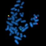 BCR-ABL as detected by FISH BCR-ABL as detected by FISH