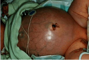 Baby with distended abdomen