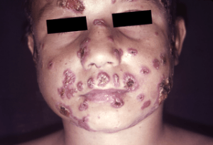 Blastomycosis
