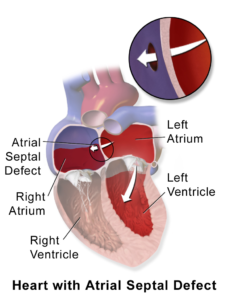 Atrial Septal Defect.