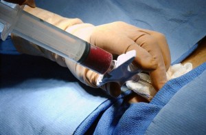 Bone marrow biopsy