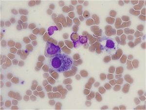 Bone marrow biopsy. Wright stain of bone marrow aspirate shows inclusions of Histoplasma capsulatum in white blood cells.