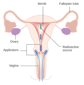 Brachytherapy for cervical cancer