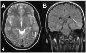 Brain-MRT-Sydenhams-Chorea