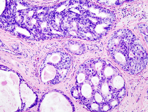 non-invasive-breast-cancer-ductal-carcinoma-in-situ-dcis-diagnosis