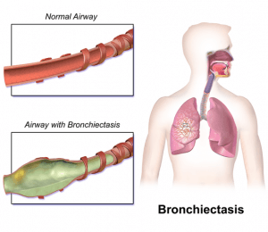 Bronchiectasis Bronchiectasis