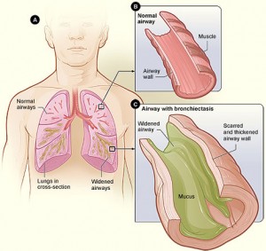 Bronchiectasis-NHLBI