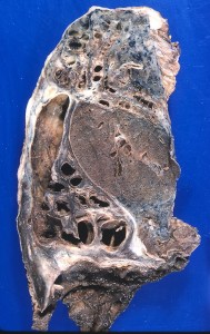 Bronchiectasis gross pathology Bronchiectasis gross pathology