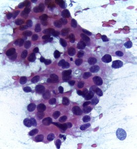 Cytopathology of infiltrating duct carcinoma breast