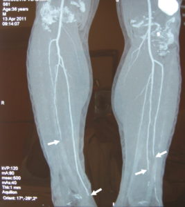 Buerger's Disease (CT-angiogram)