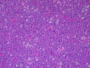 By Ed Uthman from Houston, TX, USA - Burkitt lymphoma, H&EUploaded by CFCF, CC BY 2.0, https://commons.wikimedia.org/w/index.php?curid=30103521