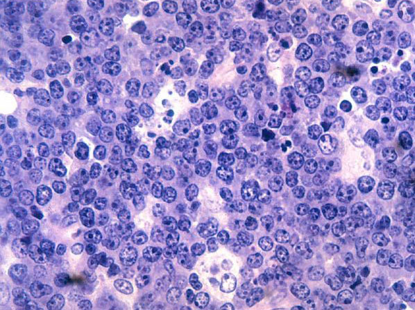 burkitt lymphoma histopathology