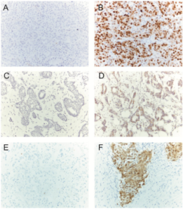 CDKs-breast-cancer-cell-cycle