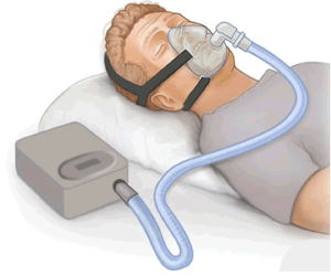 Continuous positive airway pressure cpap