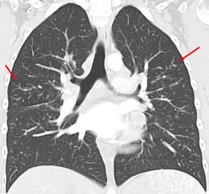 CT Scan of Sarcoidosis