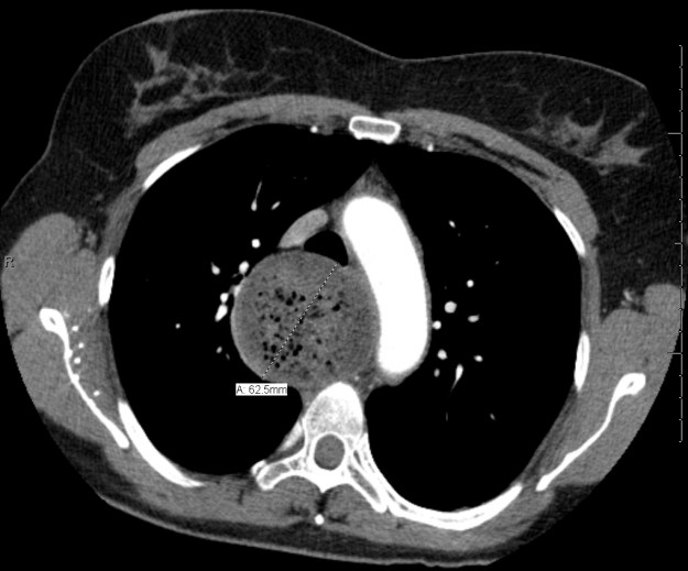 esophagus achalasia ct