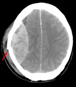 CT-scan-epidural-hematoma