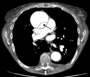 CT scan of an aortic dissection