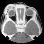 CT scan of periorbital Langerhans cell histiocytosis