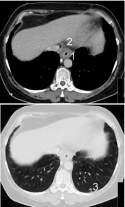 CT scan showing a circular oesophageal cancer CT scan showing a circular oesophageal cancer