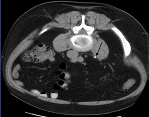 CT scan showing calculus CT scan showing calculus