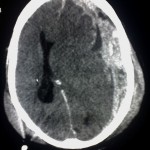 CT-scan-subdural-haemorrhage