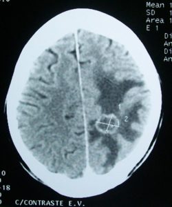 CT brain tumor