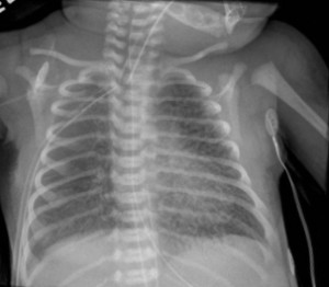 CXR Pulmonary interstitial emphysema