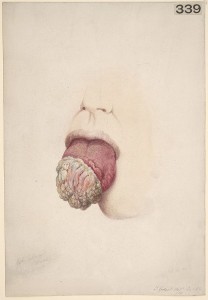 Cancer of the tongue Cancer of the tongue