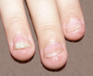candida nails