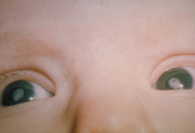 Cataracts due to CRS