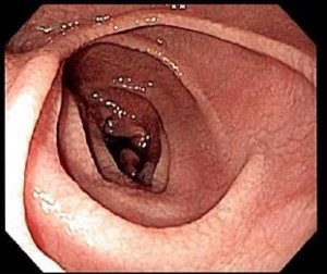 Celiac endo Celiac endo