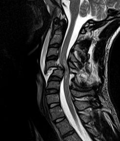 Cervical-Spine-MRI-(T2W)