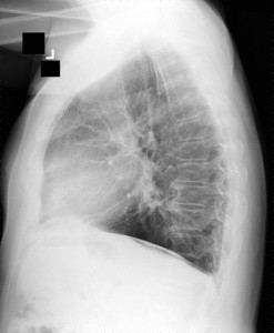Chest X-ray in asbestosis