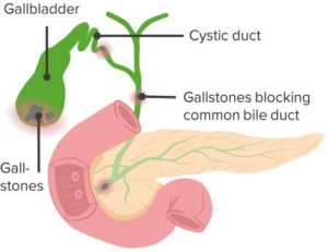 Cholecystitis