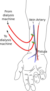 Cimino fistula Cimino fistula