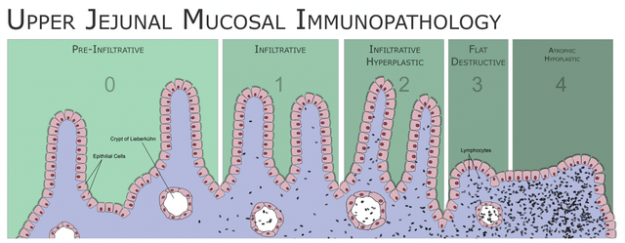 Coeliac Disease Coeliac Disease